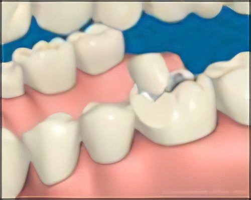 Couronne dentaire Moirans Fracture Dentaire Petite