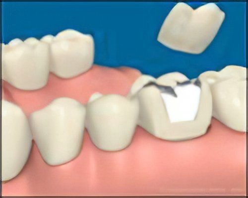 Couronne dentaire Moirans Fracture Dentaire Profonde