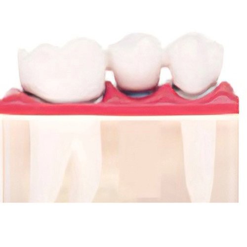 Le remplacement des dents manquantes