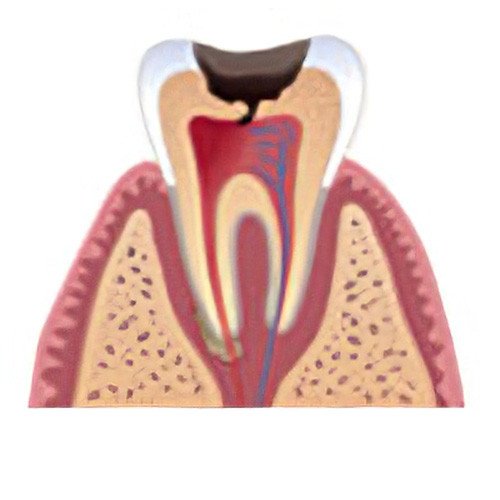 soins dentaires Moirans carie dentaire