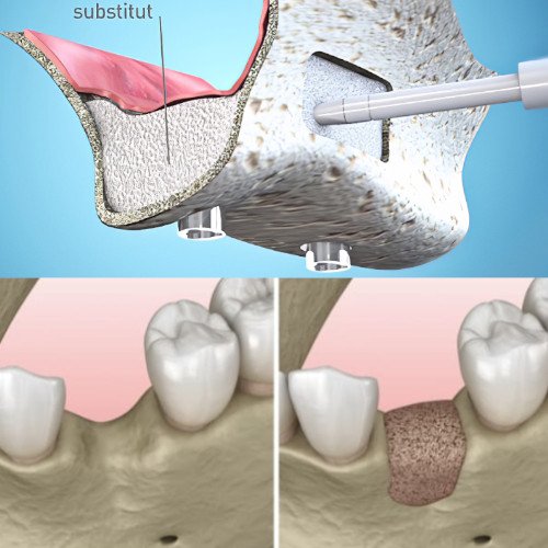 Chirurgies pre-implantaire