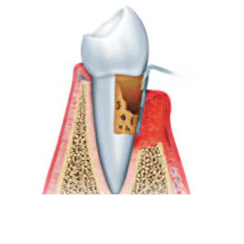 Maladie parodontale Moirans